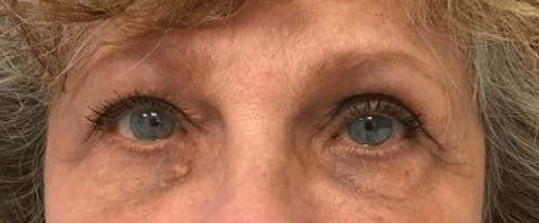 Under Eye Filler After, Female 65 - 810