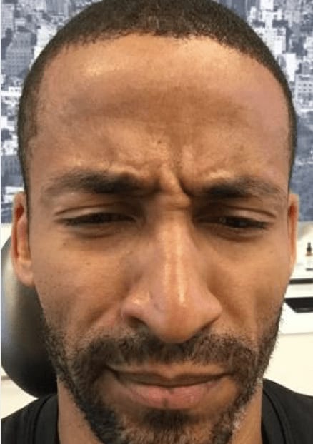 Botox Before, Male 39 - 849