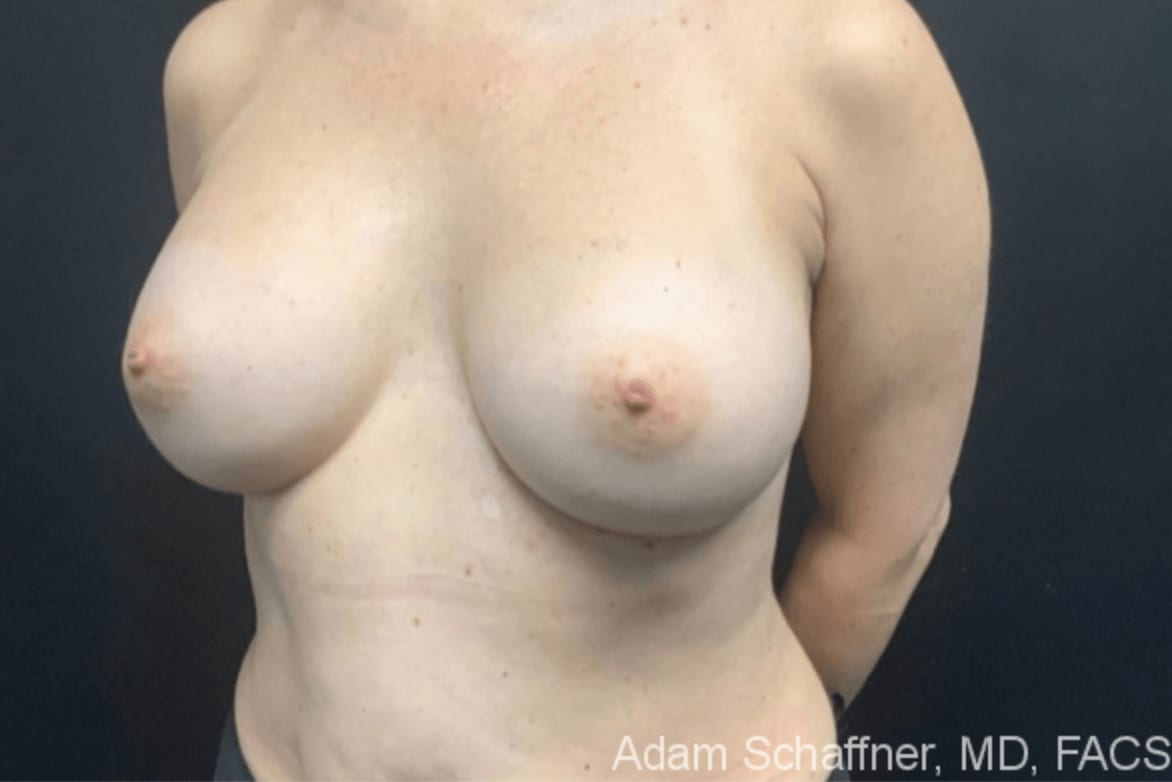 Breast Augmentation (Augmentation Mammaplasty) After, Female 32 - 894
