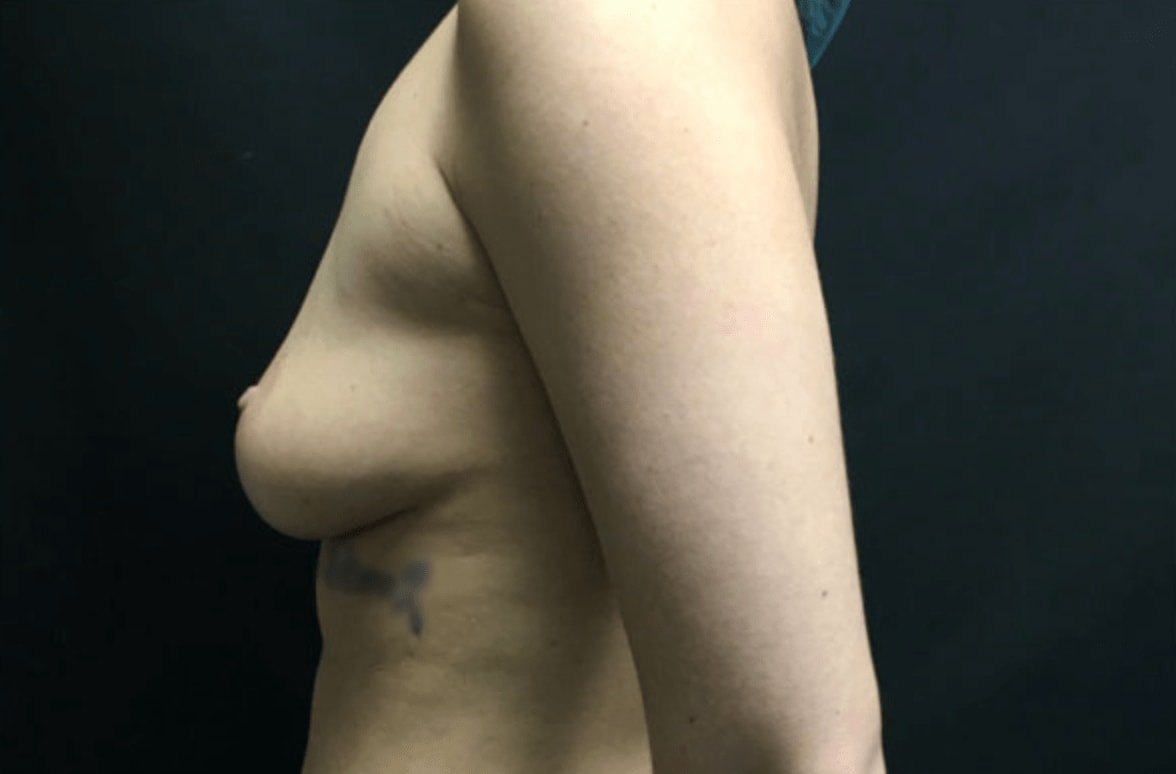 Breast Lift Before, Female 31 - 903