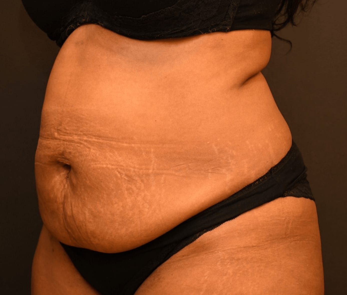 Tummy Tuck (Abdominoplasty) Before, Female 32 - 946