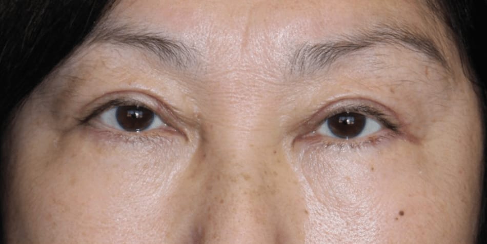 Blepharoplasty After, Female 53 - 982