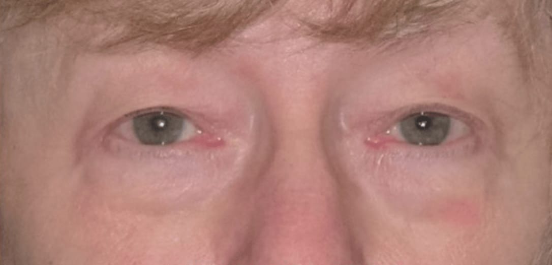 Blepharoplasty Before, Female 46 - 983