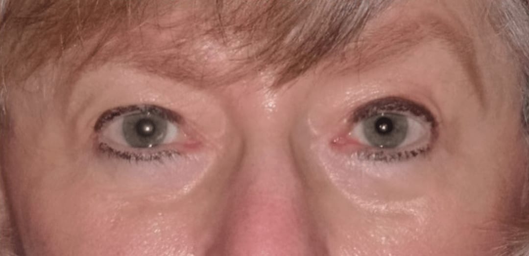 Blepharoplasty After, Female 46 - 983