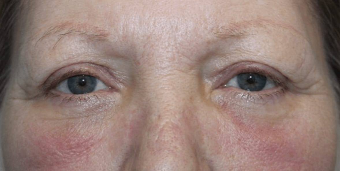 Blepharoplasty After, Female 45 - 986