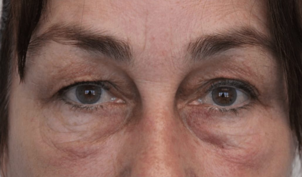 Blepharoplasty Before, Female 43 - 985