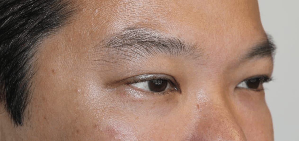 Blepharoplasty After, Male 38 - 984