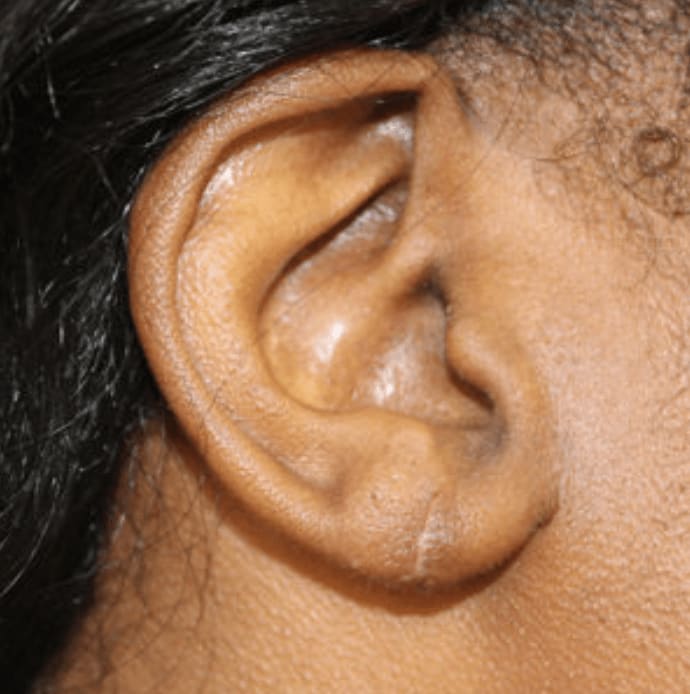Earlobe Surgery After, Female 33 - 1028