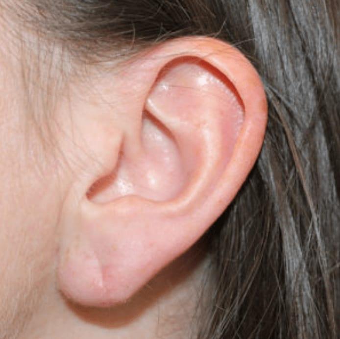 Earlobe Surgery After, Female 28 - 1029