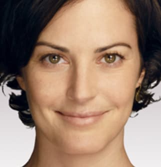 Dermal Fillers & Injectables After, Female 47 - 1387