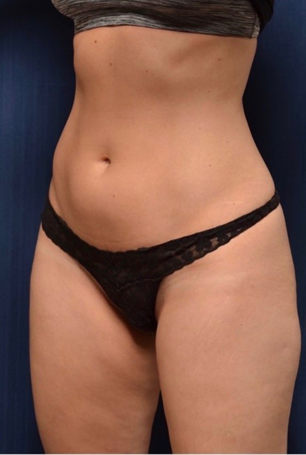 Brazilian Butt Lift Before, Female 29 - 1800