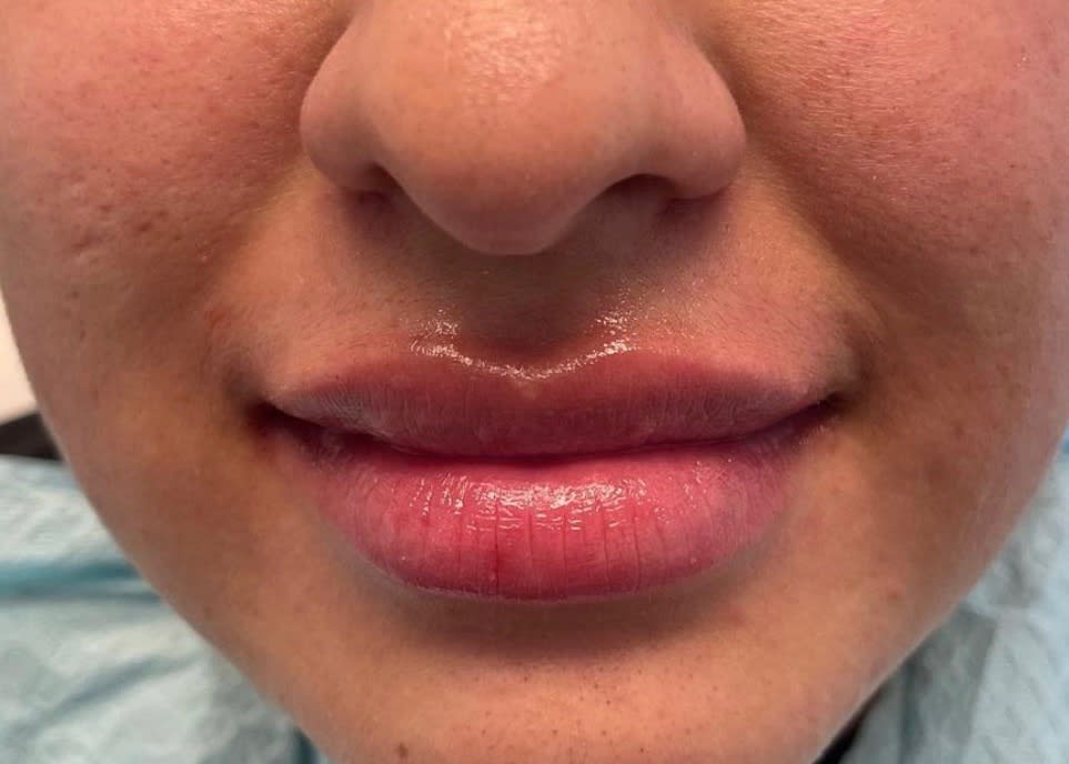 Lip Augmentation and Injections After, Female 25 - 1803