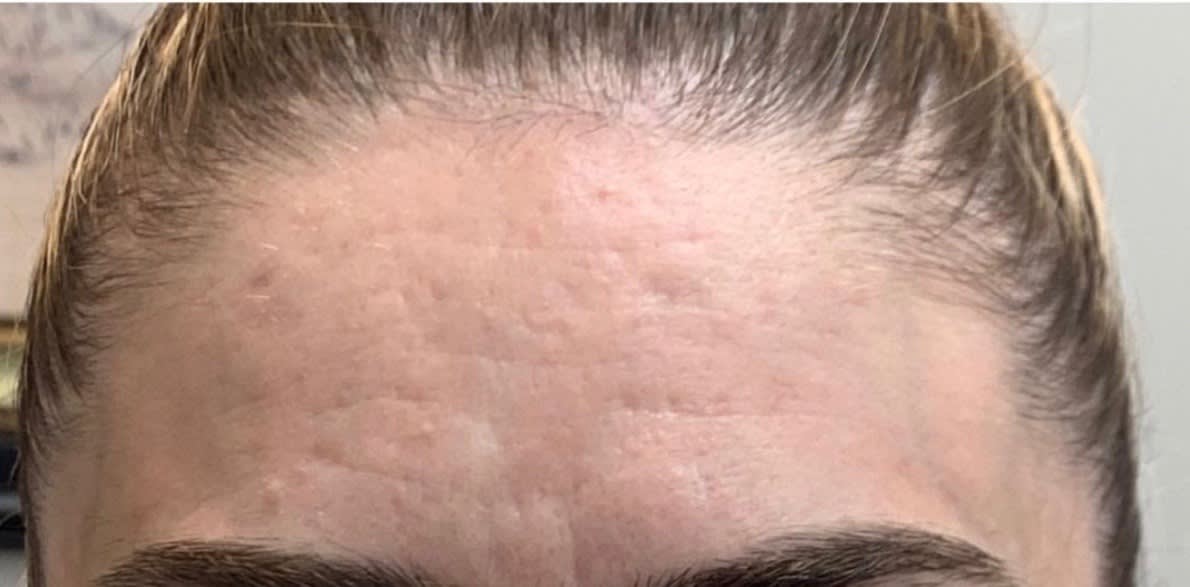 Laser Skin Resurfacing After, Female 45 - 1813