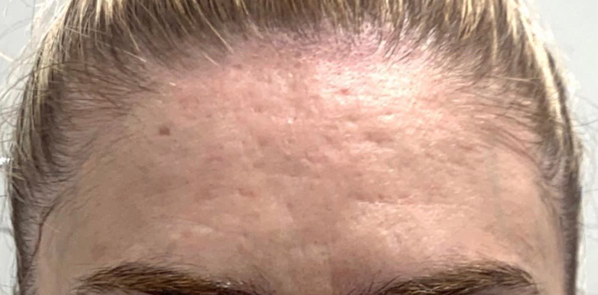 Laser Skin Resurfacing Before, Female 45 - 1813