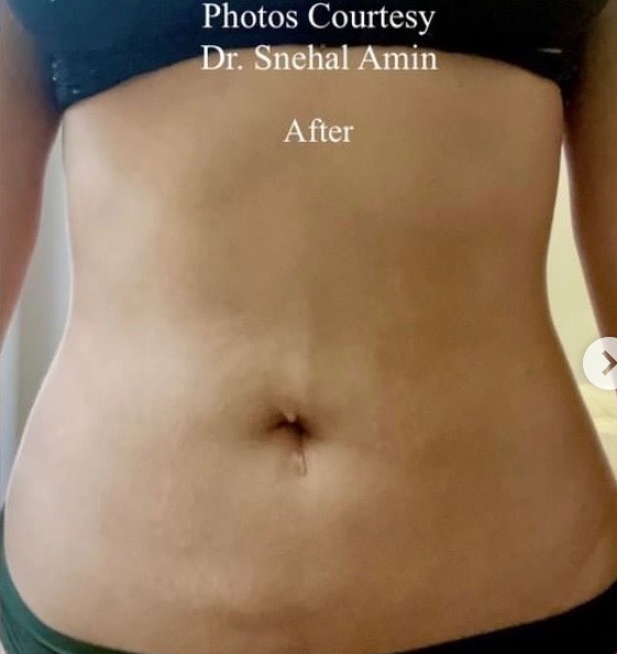 Body Contouring Solutions After, Female 34 - 1814