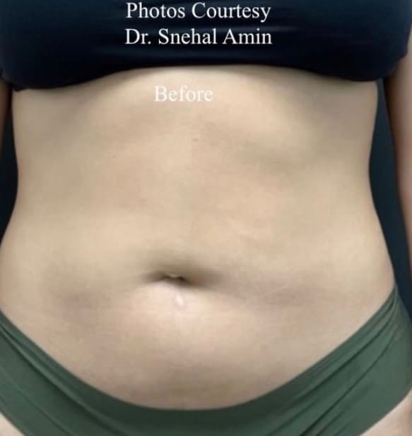 Body Contouring Solutions Before, Female 34 - 1814