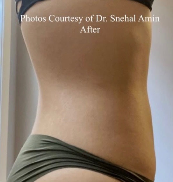 Body Contouring Solutions After, Female 34 - 1815