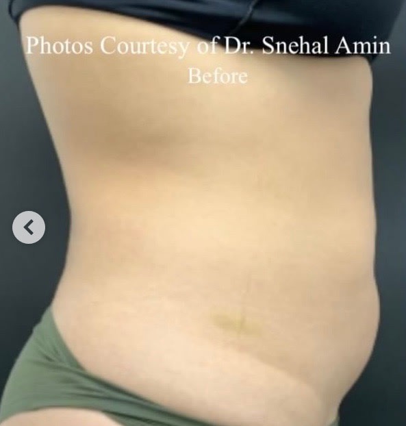Body Contouring Solutions Before, Female 34 - 1815