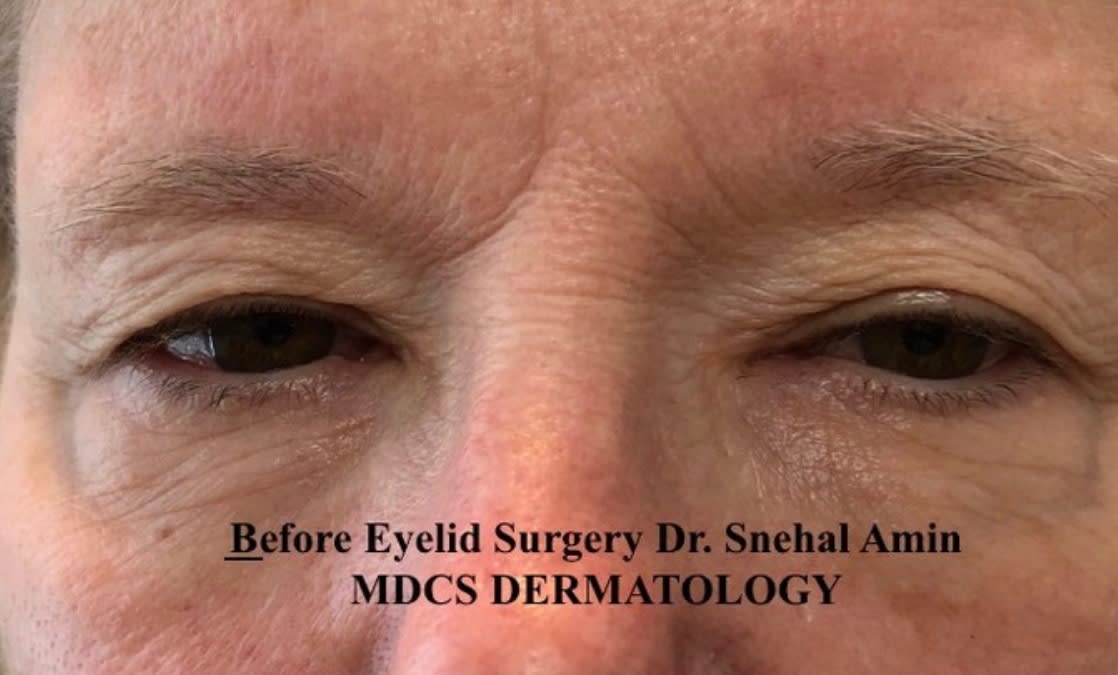 Eyelid Correction Solutions Before, Female 54 - 1818
