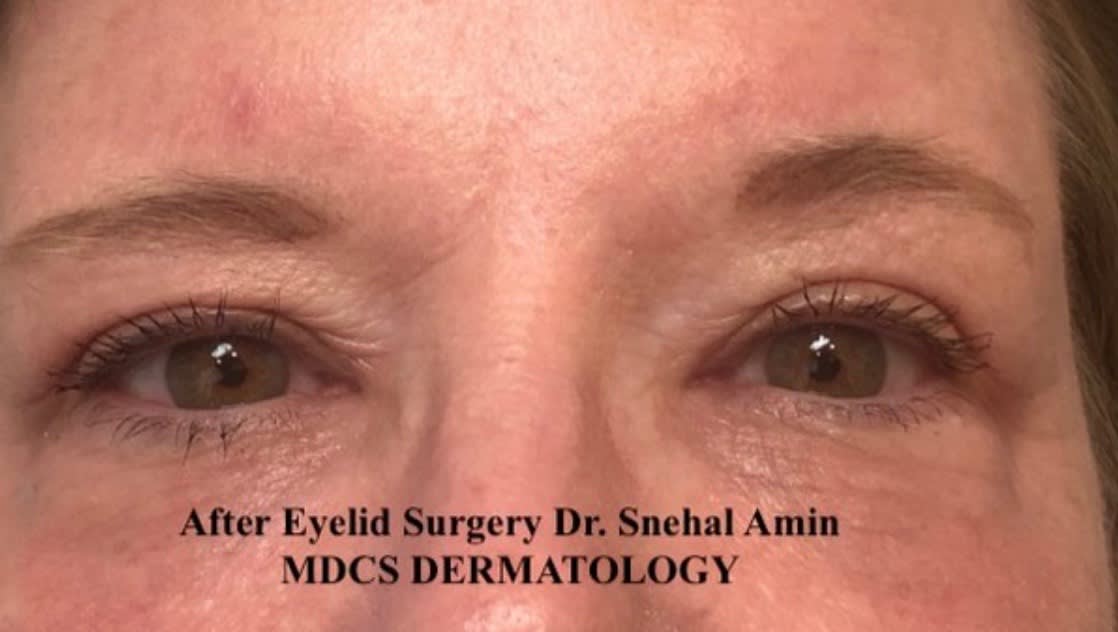 Eyelid Correction Solutions After, Female 54 - 1818