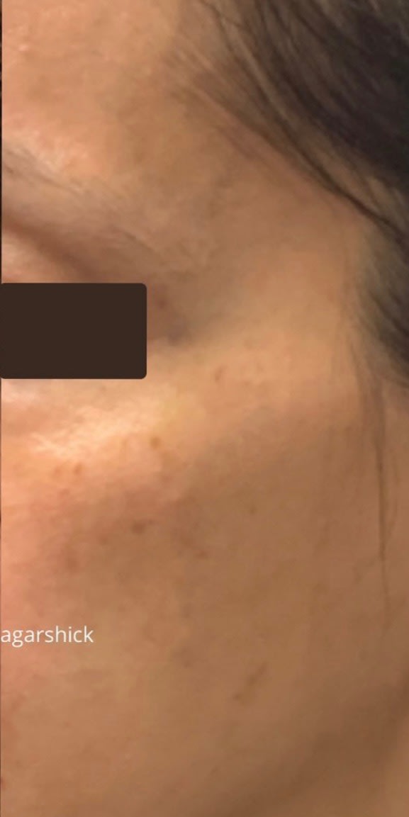 Laser Skin Resurfacing After, Female 37 - 1820