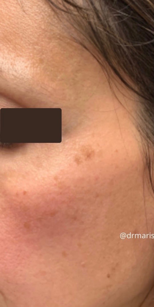Laser Skin Resurfacing Before, Female 37 - 1820