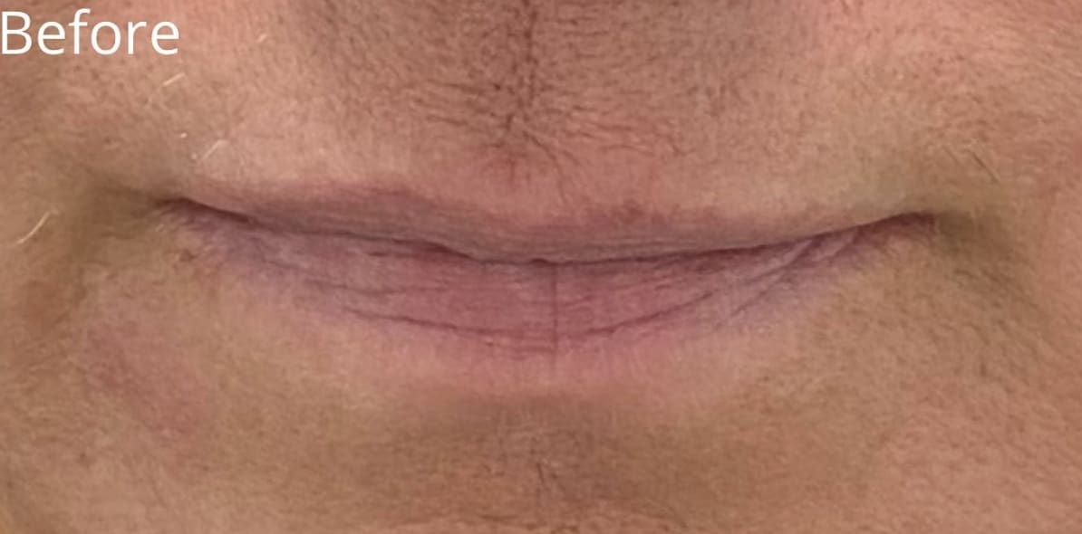 Dermal Fillers & Injectables Before, Female 50 - 1821