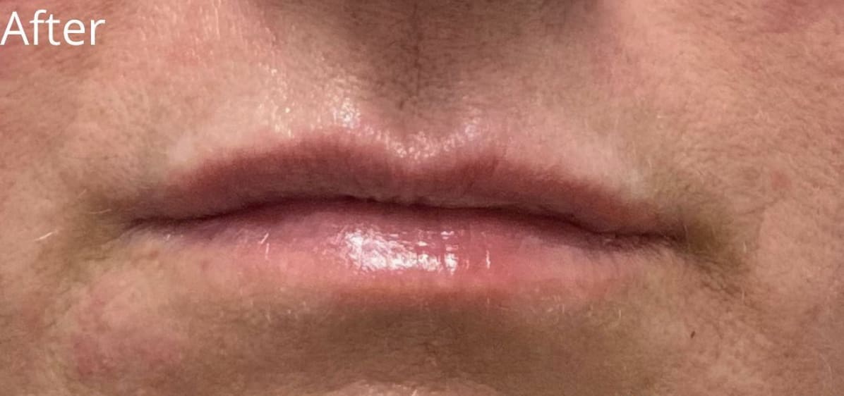 Dermal Fillers & Injectables After, Female 50 - 1821