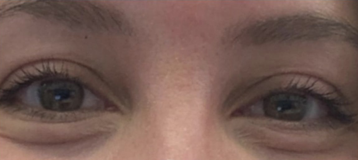 Botox Before, Female 26 - 1822