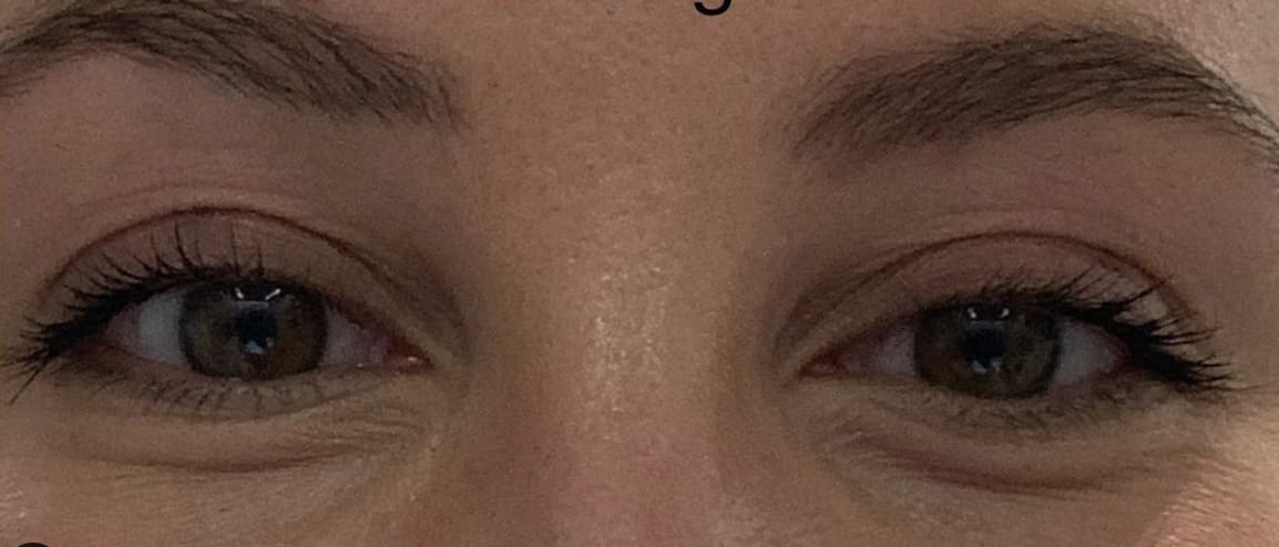 Botox After, Female 26 - 1822