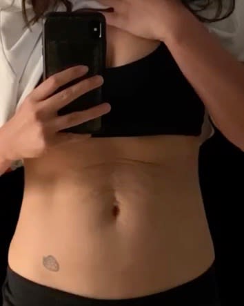 Body Contouring Solutions Before, Female 33 - 1827