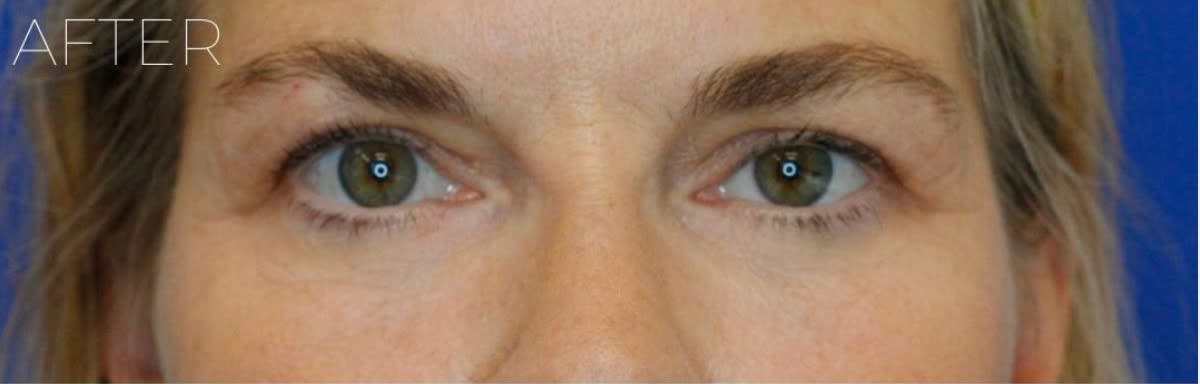Blepharoplasty After, Female 46 - 1884