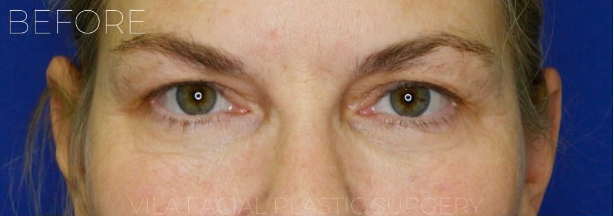 Blepharoplasty Before, Female 46 - 1884