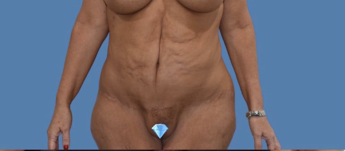 Abdominoplasty Before, Female 39 - 2070