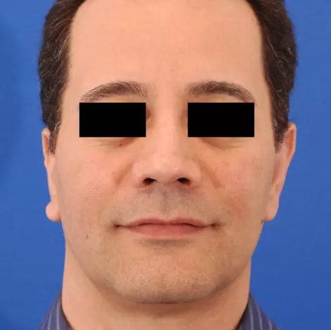 Revision Rhinoplasty After, Male 40 - 2808