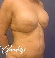 Breast Augmentation (Augmentation Mammaplasty) After, Female 48 - 3091