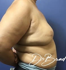 Breast Augmentation (Augmentation Mammaplasty) Before, Female 48 - 3093