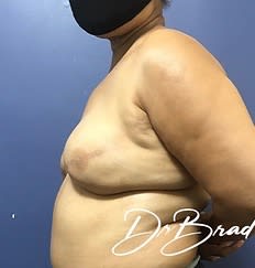 Breast Augmentation (Augmentation Mammaplasty) Before, Female 48 - 3094