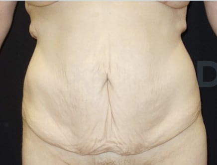 Abdominal Slimming Solutions Before, Female 37 - 3136