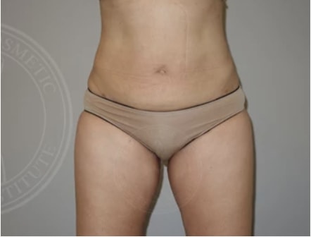Liposuction After, Female 49 - 3139
