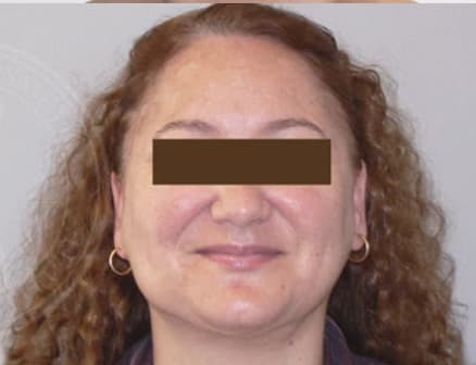 Liposuction After, Female 40 - 3140
