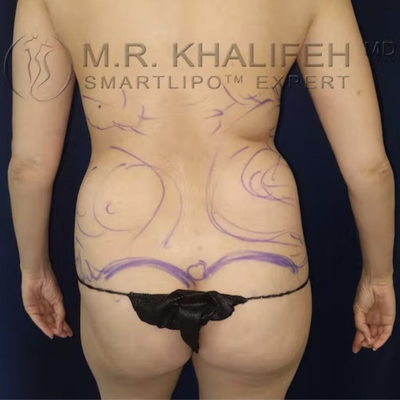 Liposuction Before, Female 33 - 3170