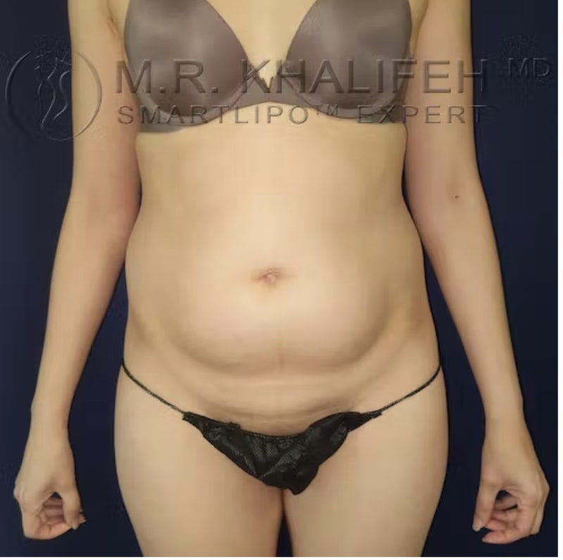 Liposuction Before, Female 33 - 3169