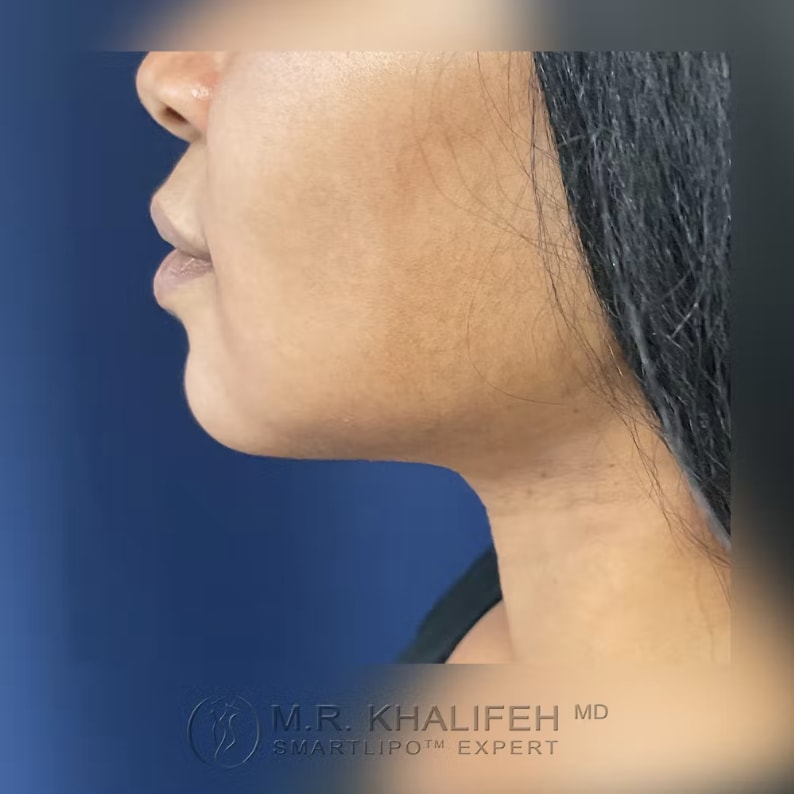 Buccal Fat Removal After, Female 36 - 3180