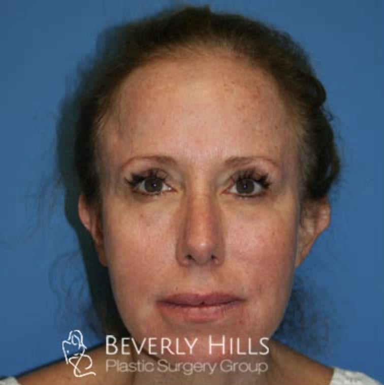 Facelift Before, Female 55 - 3328