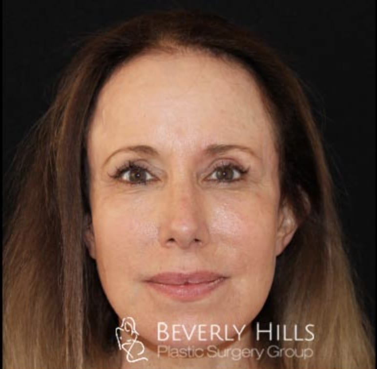 Facelift After, Female 55 - 3328