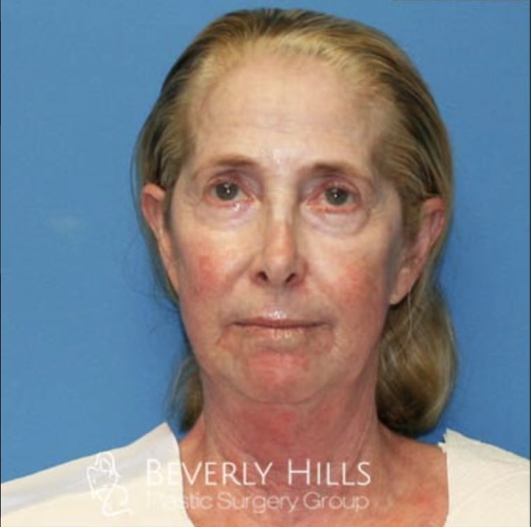 Facelift Before, Female 62 - 3331