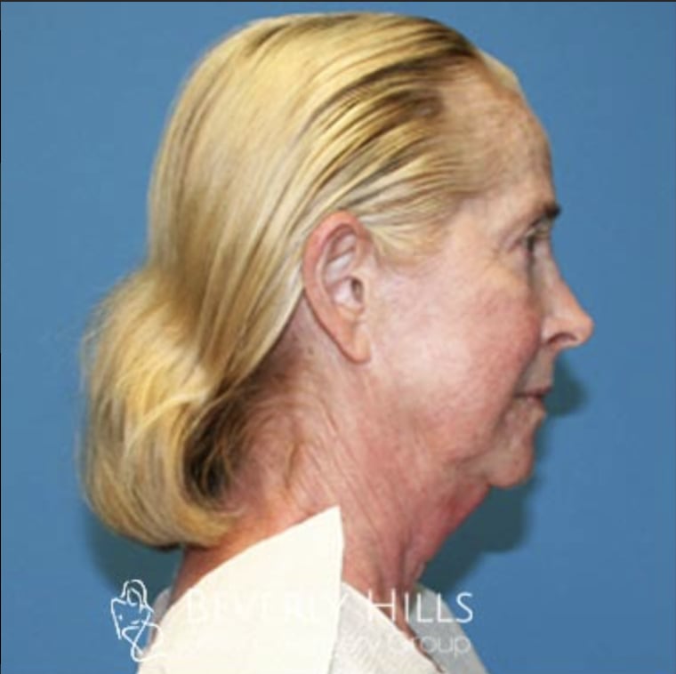 Facelift Before, Female 62 - 3332