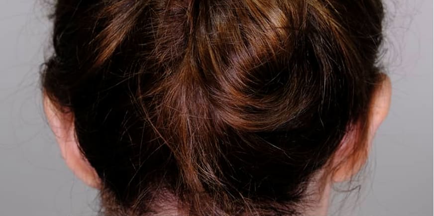 Otoplasty Before, Female 37 - 3333