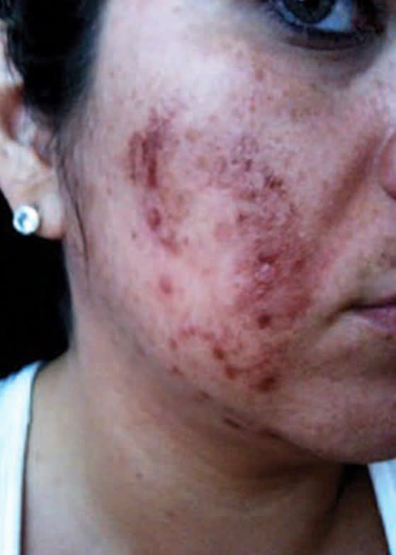 Acne Treatment Before, Female 28 - 3327